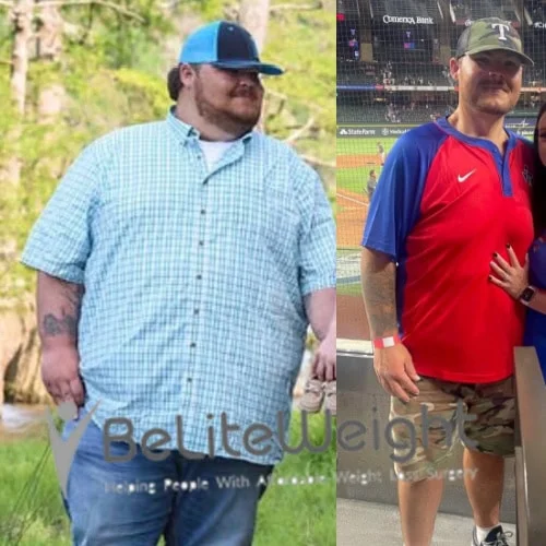 Weight Loss Surgery Before And After